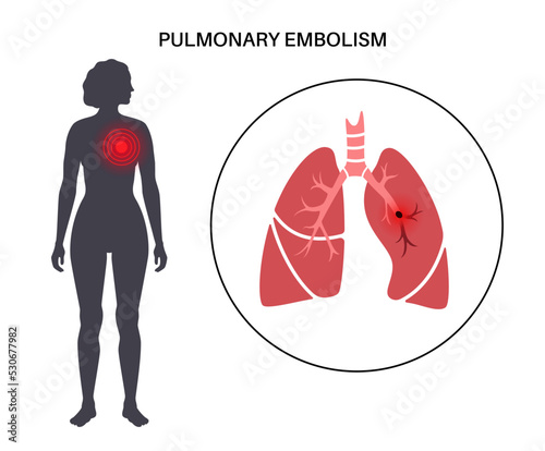 Pulmonary embolism disease