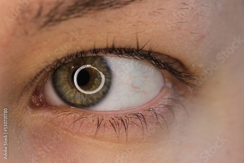 Hazel is the eye of a middle-aged Slavic woman.A black floating spot in the eye as a symptom of diabetes. Retinopathy.