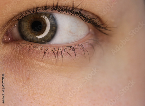 Hazel is the eye of a middle-aged Slavic woman.A black floating spot in the eye as a symptom of diabetes. Retinopathy.