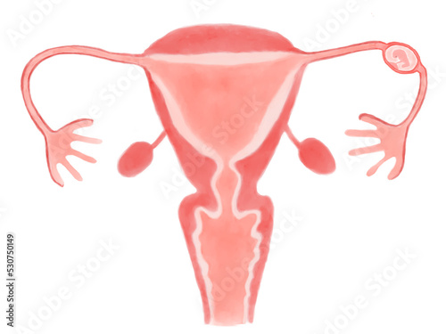 子宮外妊娠（卵管妊娠）の水彩イラスト photo