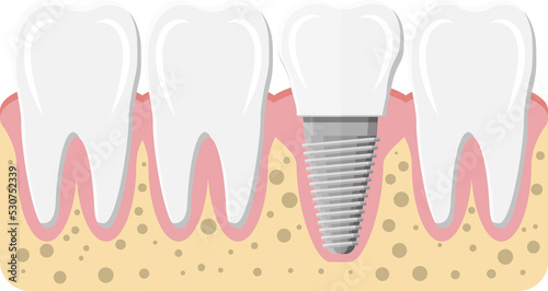 Tooth restoration, dental implant