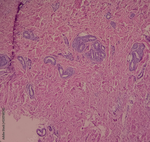 Microscopic image of branchial cyst, branchial sinus, show cyst wall of fibrocollagenous tissue by squamous epithelium.