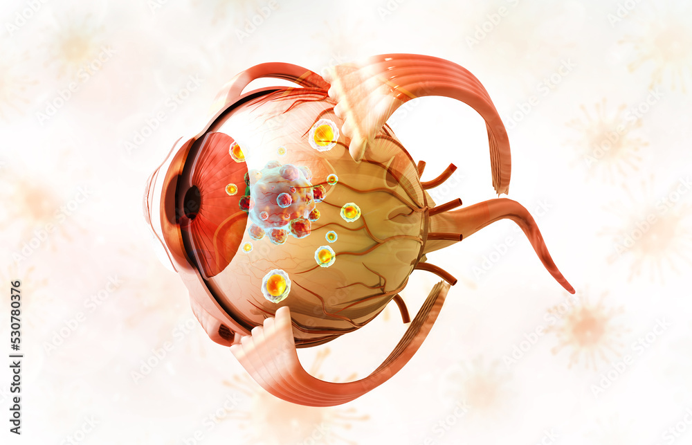 Human eye cancer concept. Eye anatomy. 3d illustration. Stock