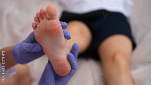 Infectious disease doctor examining rash on skin of child feet closeup photo