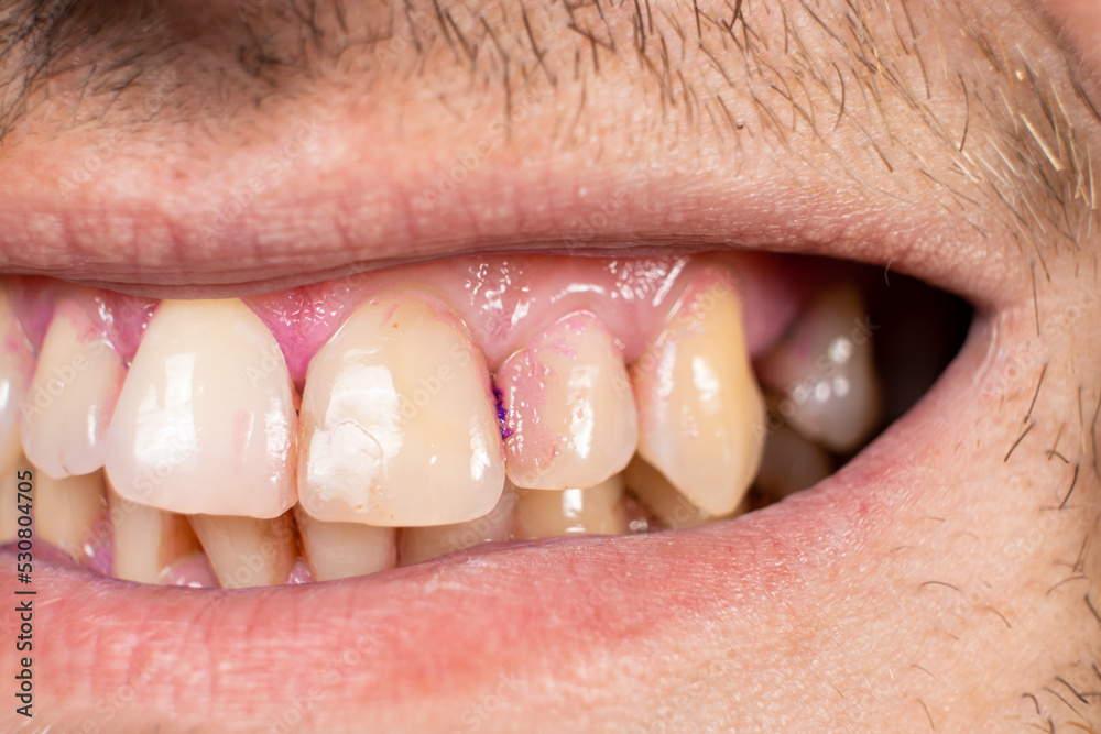 Plaque on human teeth is colored pink with indicator tablets. Plaque on human teeth is colored pink with indicator tablets.