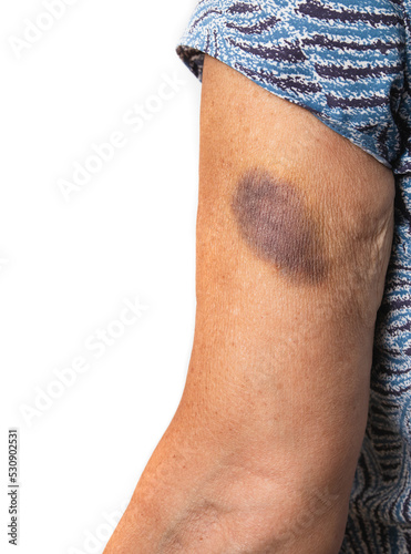 Senior arm with bruise. Woman with large blue and purple mark from falling or accident. Or contusions from medical reasons such as blood thinner, vitamin deficiency or hematoma. Selective focus. photo