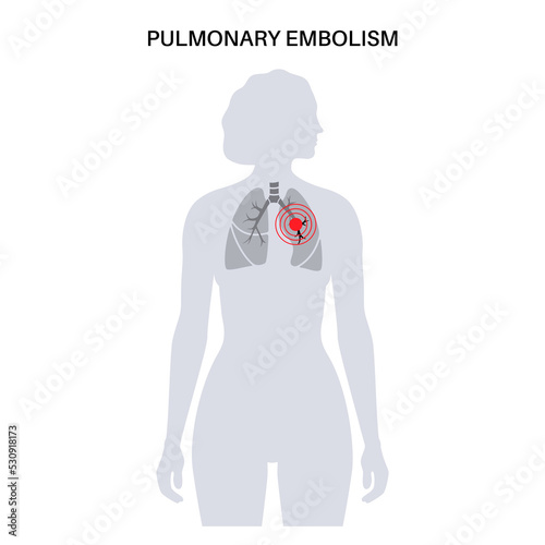 Pulmonary embolism disease