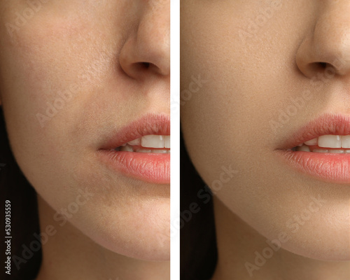 Billede på lærred Collage with photos of woman having dry skin problem before and after moisturizi