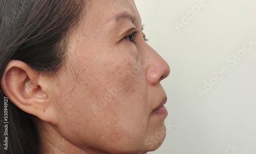 portrait showing the Freckles and blemish on the cheek, ptosis beside the eyelid, problem dark spots and dull skin on the face of the woman, concept health care.