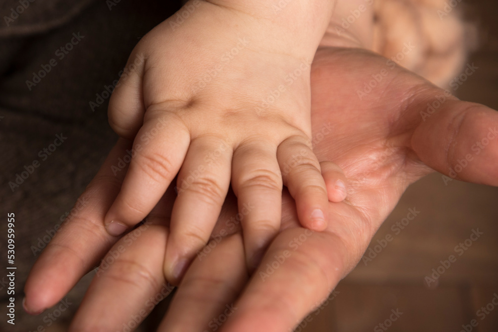 Polydactyly baby hand genetic condition Polydactyly baby hand genetic condition
