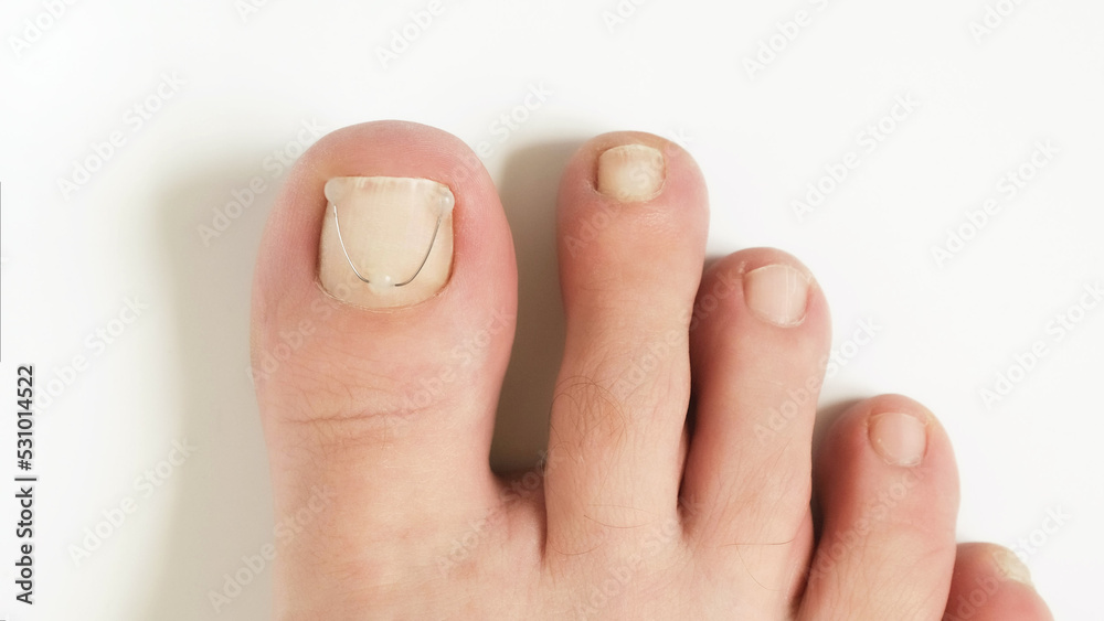 Titanium thread on the nail of the big toe. Ingrown toenail treatment Stock  Photo | Adobe Stock