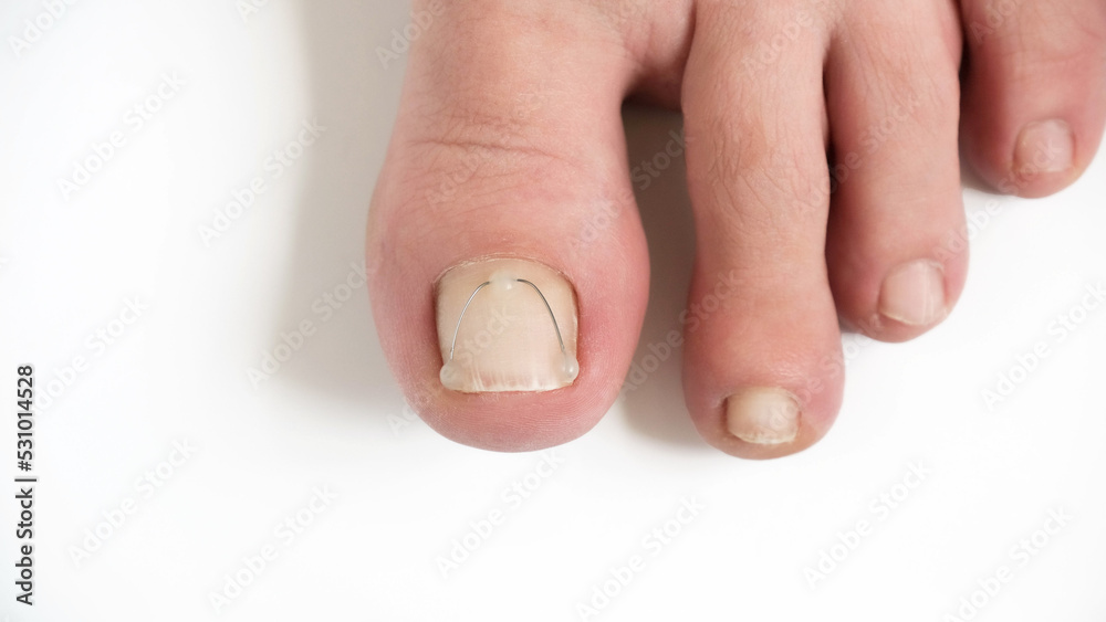 Titanium thread on the nail of the big toe. Ingrown toenail treatment Titanium thread on the nail of the big toe. Ingrown toenail treatment