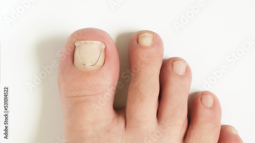 Titanium thread on the nail of the big toe. Ingrown toenail treatment photo