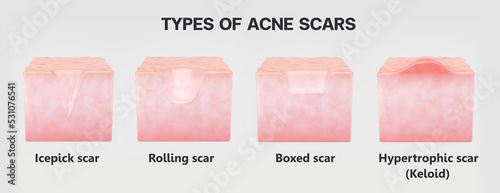 Type of acne for Acne treatment product and clinic.
