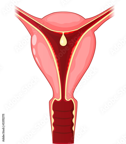 Uterine polyp. Human uterus with Endometrial polyp photo