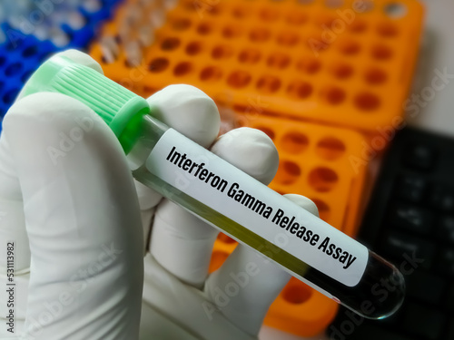 Blood sample for Interferon Gamma Release Assay (IGRA) test for diagnosis of Tuberculosis photo