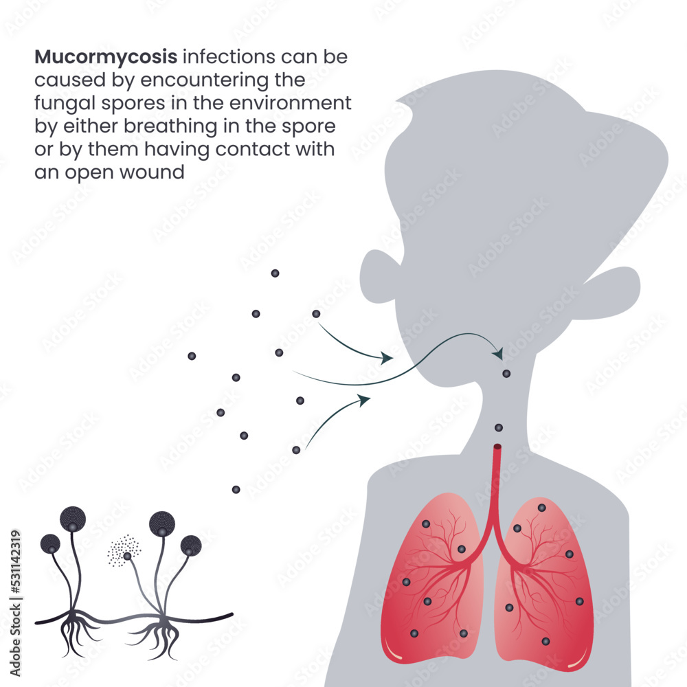 Mucormycosis black fungus infection in the lungs through inhaled spores ...