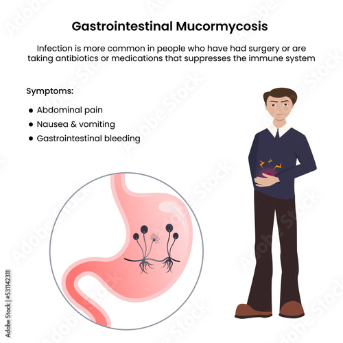 Gastrointestinal or Primary Gastric mucormycosis black fungal infection vector illustration photo