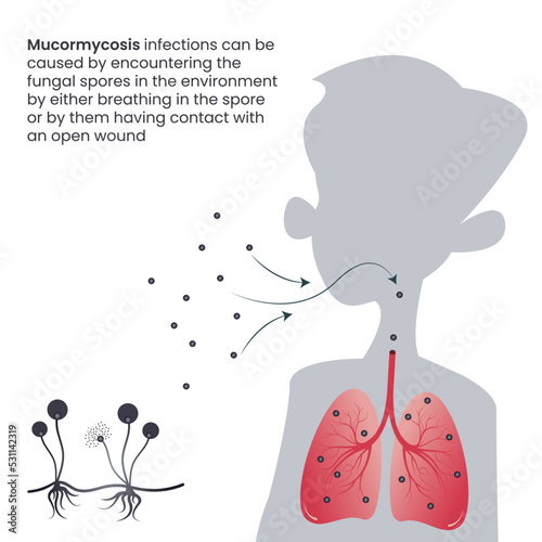 Mucormycosis black fungus infection in the lungs through inhaled spores photo
