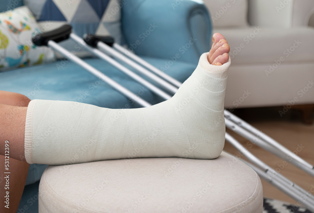 broken ankle and a leg cast. Leg splint Photos | Adobe Stock