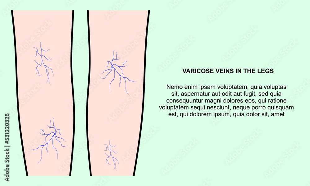 Varicose veins in the legs, template banner. Varicose spider veins