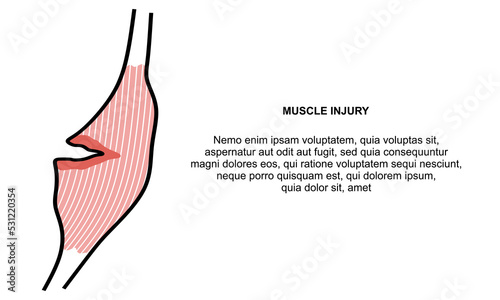 Muscle injury Banner. Muscle pain template banner. Pulled Hamstring Isolated on white background. Hamstring Strain symbol.  muscle vector illustration