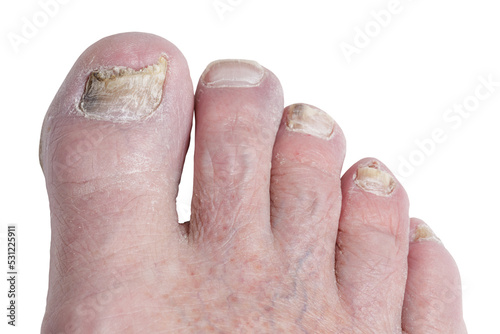 Close up of foot with toenail fungus or athletes foot photo