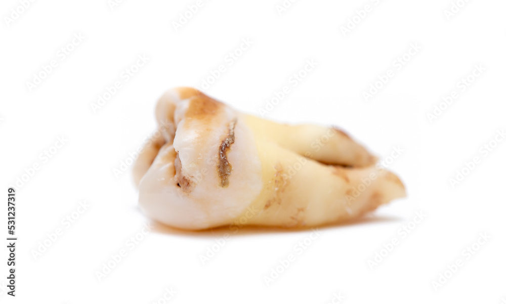 Close-up of a tooth with caries isolated on a white background. Removed wisdom teeth. Sick human teeth. Close-up of a tooth with caries isolated on a white background. Removed wisdom teeth. Sick human teeth.