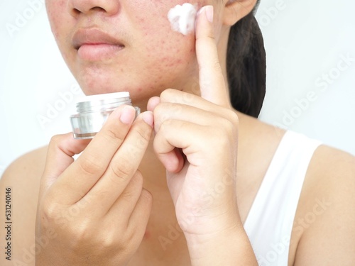 Young woman holding cream jar and applying acne cream on her face for treat her skin. Concept of beauty and cosmetic. Closeup photo, blurred.