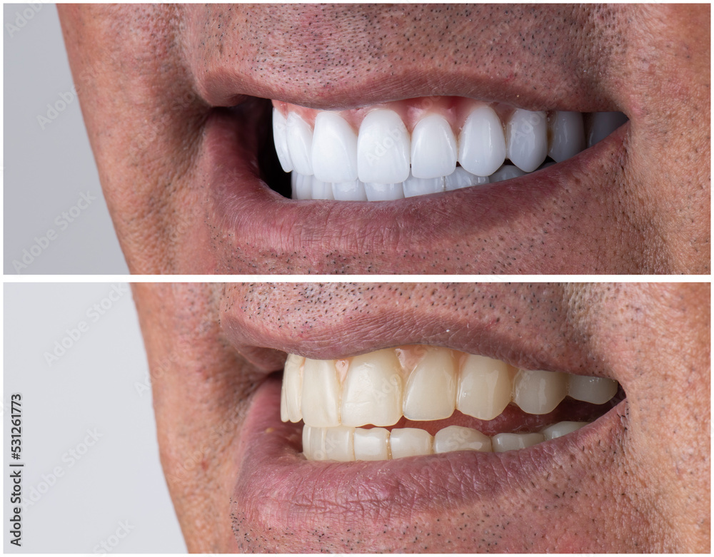 Obraz premium dental job photography, crowns veneers implants