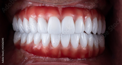 dental job photography, crowns veneers implants