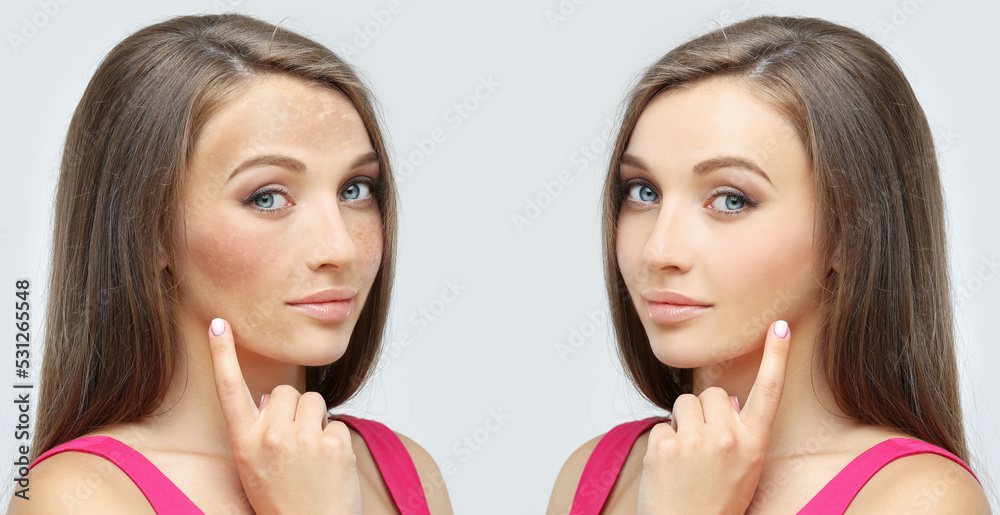 Dark spots, freckles,hyperpigmentation(melasma or chloasma),concept - skin lightening, skin whitening, fruit acids,AHA, Skin Brightening Dark spots, freckles,hyperpigmentation(melasma or chloasma),concept - skin lightening, skin whitening, fruit acids,AHA, Skin Brightening