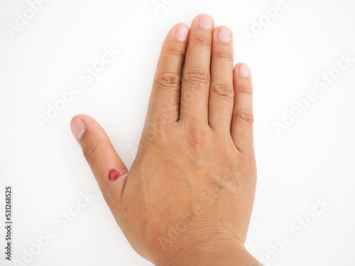 Thumb hurt with red cutout skin showing. Closeup photo, blurred. © Bungon