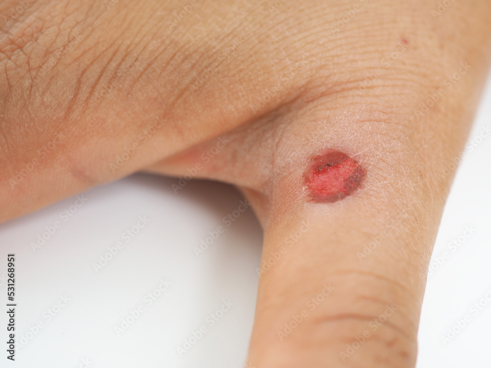 Thumb hurt with red cutout skin showing. Closeup photo, blurred. Thumb hurt with red cutout skin showing. Closeup photo, blurred.