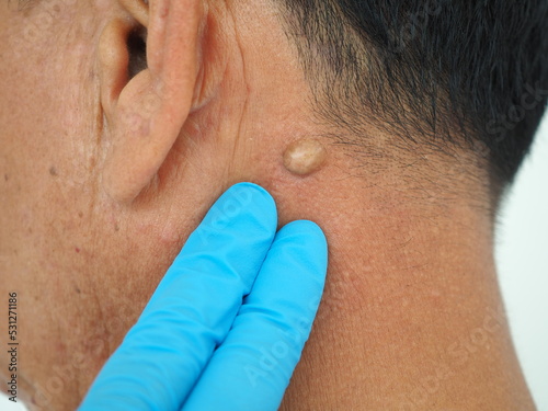 Man pointed to sebaceous cysts on his neck, formed by sebaceous glands. Oils called sebum and laser skin treatments or flea biopsies health concept. closeup photo, blurred.
