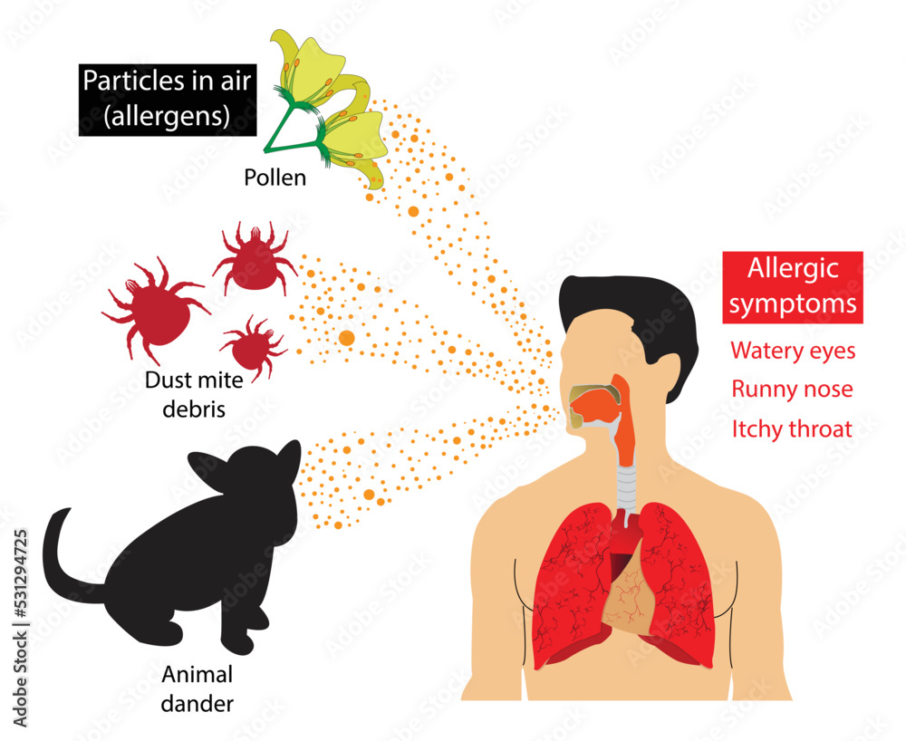 illustration of medical and Pollution, Symptoms of airborne allergies ...
