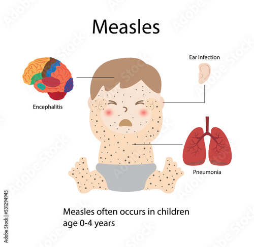 illustration of biology and medical, Measles is an acute viral respiratory illness, It is characterized by a prodrome of fever and malaise, cough, coryza photo