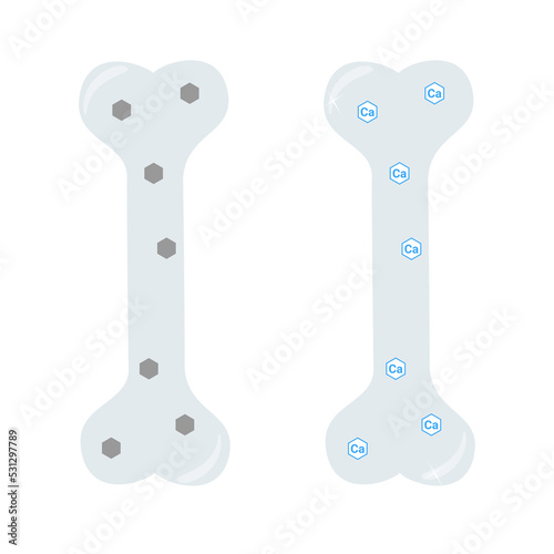 Vector illustration. Osteoparosis, diseased and healthy bone