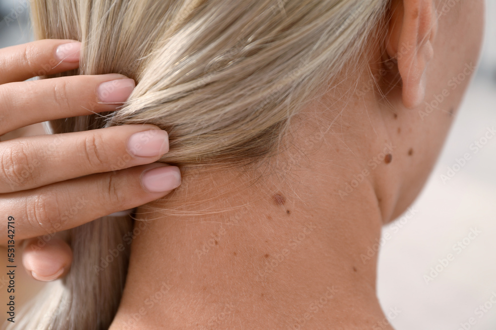 Closeup of woman`s body with birthmarks indoors, back view Closeup of woman`s body with birthmarks indoors, back view