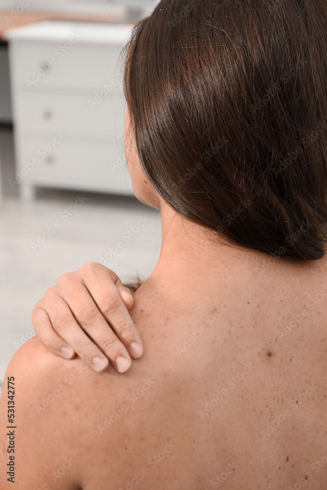 Closeup of woman`s body with birthmarks indoors, back view Closeup of woman`s body with birthmarks indoors, back view