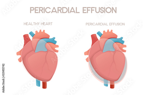 Healthy human heart and heart with pericarditis disease anatomy illustration health problem vector illustration on white background photo