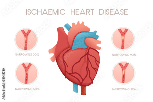 Unhealthy human heart with ischemic disease anatomy illustration health problem vector illustration on white background