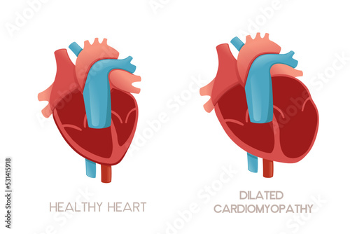 Healthy human heart and heart with dilated cardiomyopathy disease anatomy illustration health problem vector illustration on white background