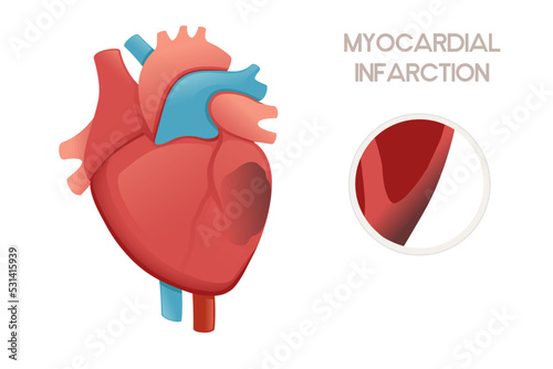 Unhealthy human heart with Myocardial infarction disease anatomy illustration health problem vector illustration on white background