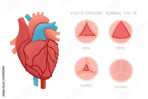 Healthy human heart with valves and valve stenosis disease anatomy illustration health problem vector illustration on white background photo