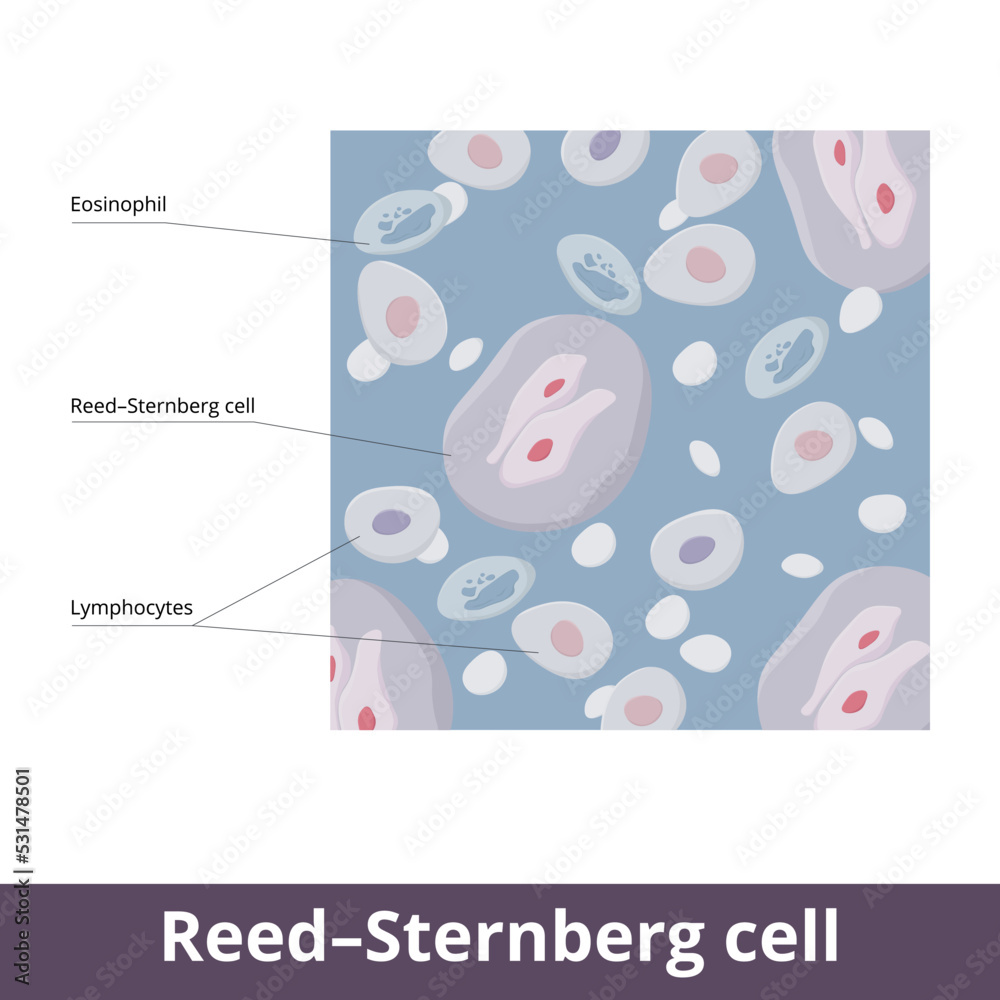 Reed–Sternberg cell. Giant cells found in biopsies from individuals with Hodgkin lymphoma. Common cells for blood cancer: eosiophile, lymphocyte, reed sternberg cell. 