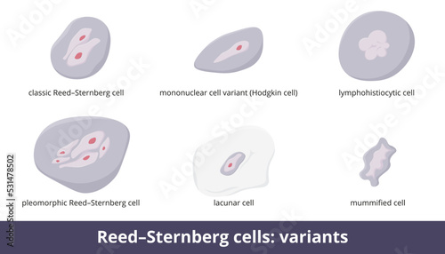 Reed–Sternberg cells. Six variants: classic, mononuclear cell variant or Hodgkin cell, lacunar, mummified and anaplastic cell, predominant (LP cell). photo