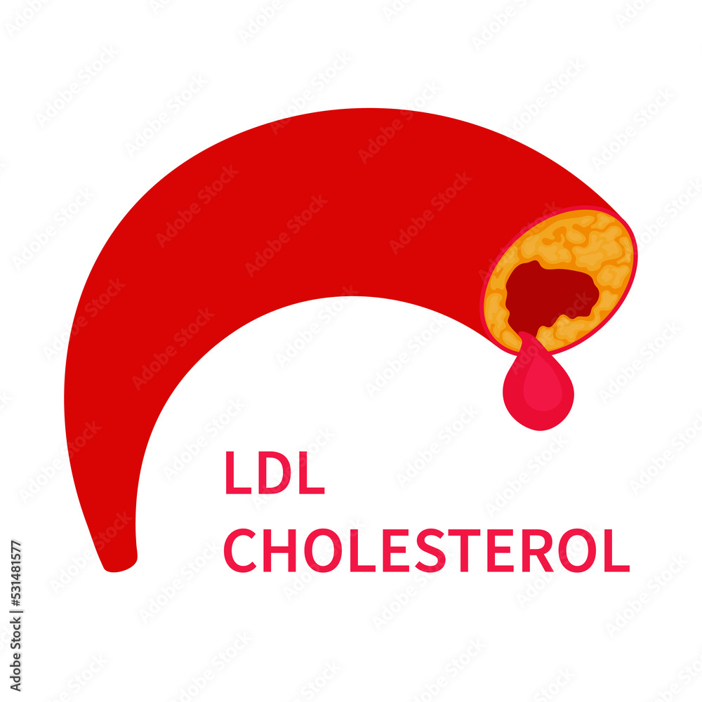 LDL cholesterol level causing blood clot in a vessel. ldl lipoprotein