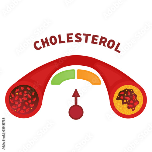 Cholesterol level in healthy and blocked blood vessel medical diagram. Meter gauge of ldl and hdl lipoprotein. High and low fat test indicator. Atherosclerosis risk. Healthcare concept illustration.