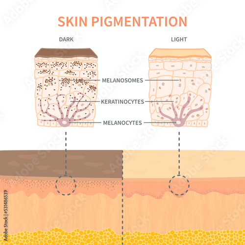 Comparison of melanosomes distribution in dark and light skin. Pigmentation mechanism in different phototypes. Close up of epidermis cross-section. Infographic medical diagram. Vector illustration. photo